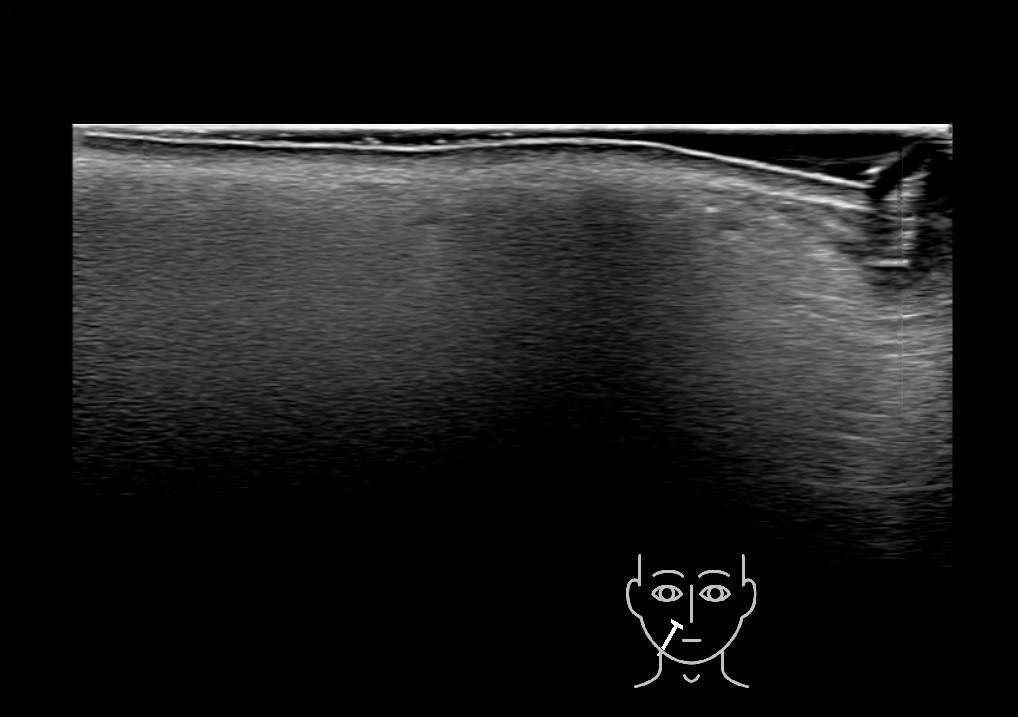 ST 1 S Cutaneous