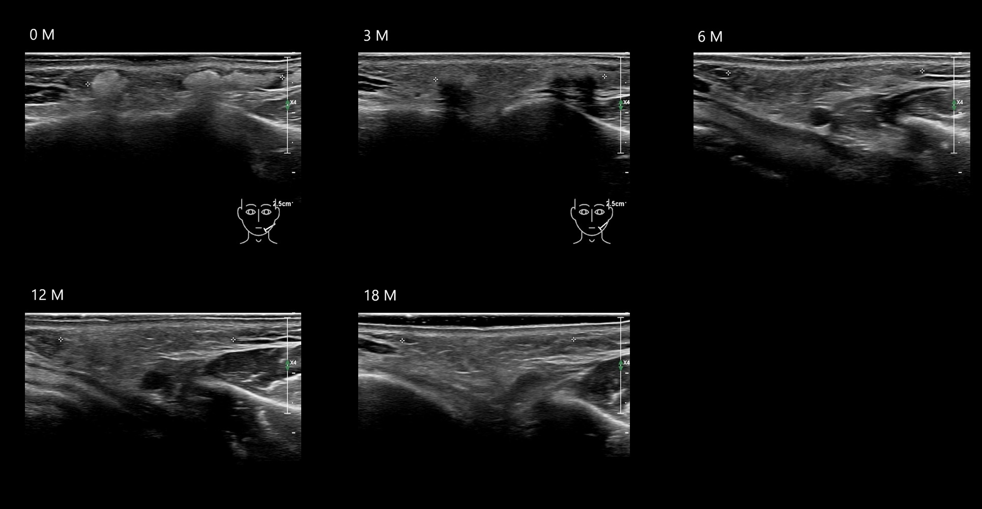 HAca 18b e - Image 4